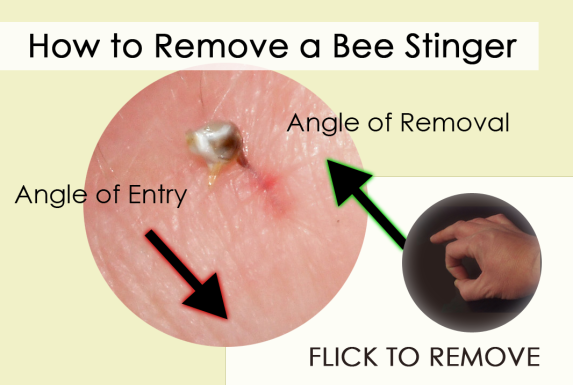 How to Remove a Bee Stinger